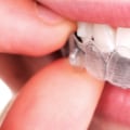 What To Expect When Your Dentist Has A Dental Assistant With Them During Your Invisalign Treatment In Austin