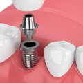 Dental Assistants Role In A Dental Implant Procedure In Texas