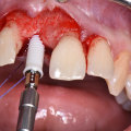 Behind The Scenes Of Dental Implants In Waco: The Crucial Role Of Dental Assistants