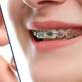 Dental Assistants: The Unsung Heroes Of Teeth Whitening In Sydney
