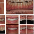 Dental Veneers In Ellsworth: How Dental Assistants And Dentists Can Help You Achieve Your Dream Smile