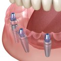 The Role Of Dental Assistants In All On 4 Dental Implant Surgery In Sydney