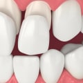 The Best Dental Assistants In Spring, TX Who Can Assist With Porcelain Veneers