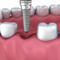 The Crucial Role Of Dental Assistants In San Antonio's Dental Implant Procedures