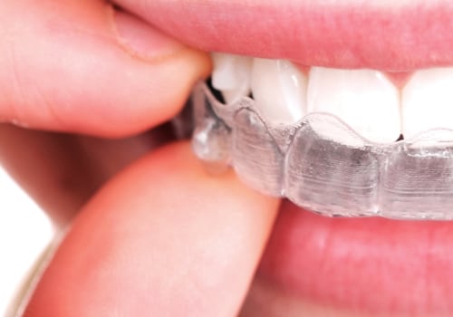 What To Expect When Your Dentist Has A Dental Assistant With Them During Your Invisalign Treatment In Austin