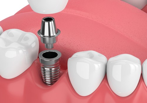 Dental Assistants Role In A Dental Implant Procedure In Texas