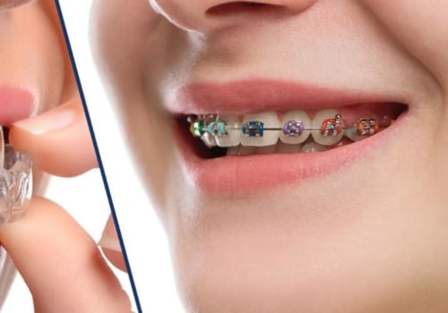 Dental Assistants: The Unsung Heroes Of Teeth Whitening In Sydney