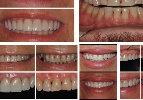 Dental Veneers In Ellsworth: How Dental Assistants And Dentists Can Help You Achieve Your Dream Smile