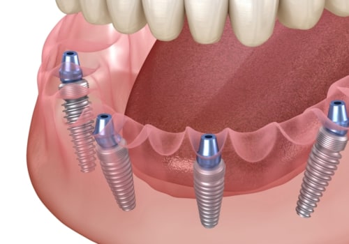 The Role Of Dental Assistants In All On 4 Dental Implant Surgery In Sydney