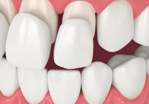 The Best Dental Assistants In Spring, TX Who Can Assist With Porcelain Veneers