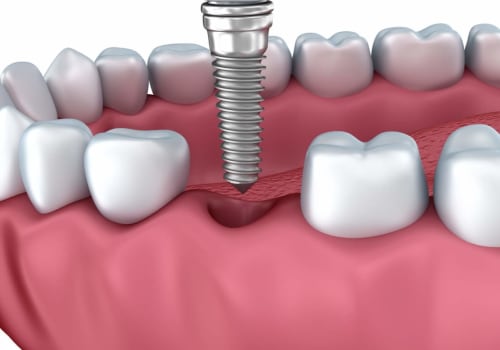 The Crucial Role Of Dental Assistants In San Antonio's Dental Implant Procedures